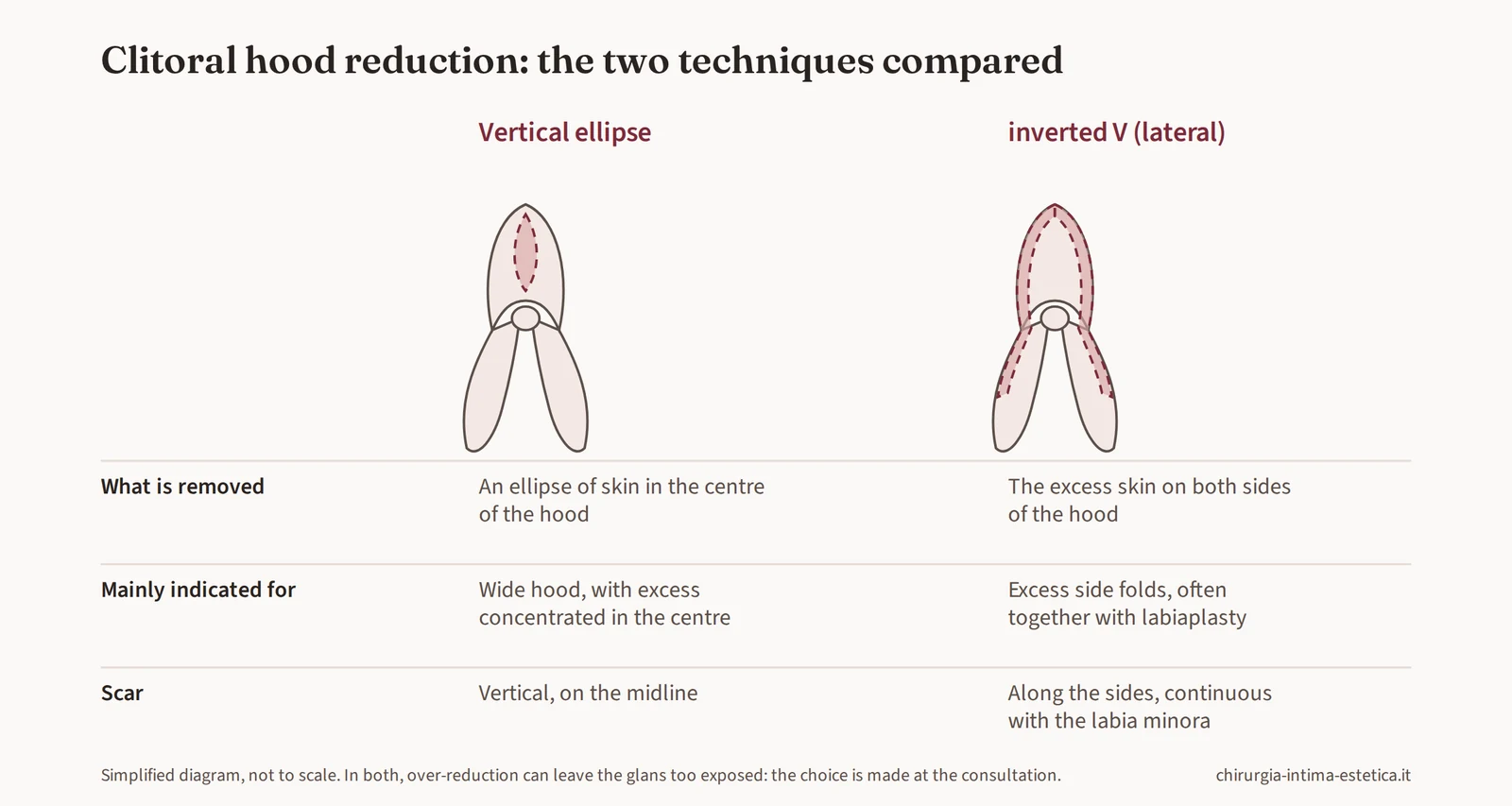 Diagram comparing the two clitoral hood reduction techniques: central vertical diamond and lateral inverted V