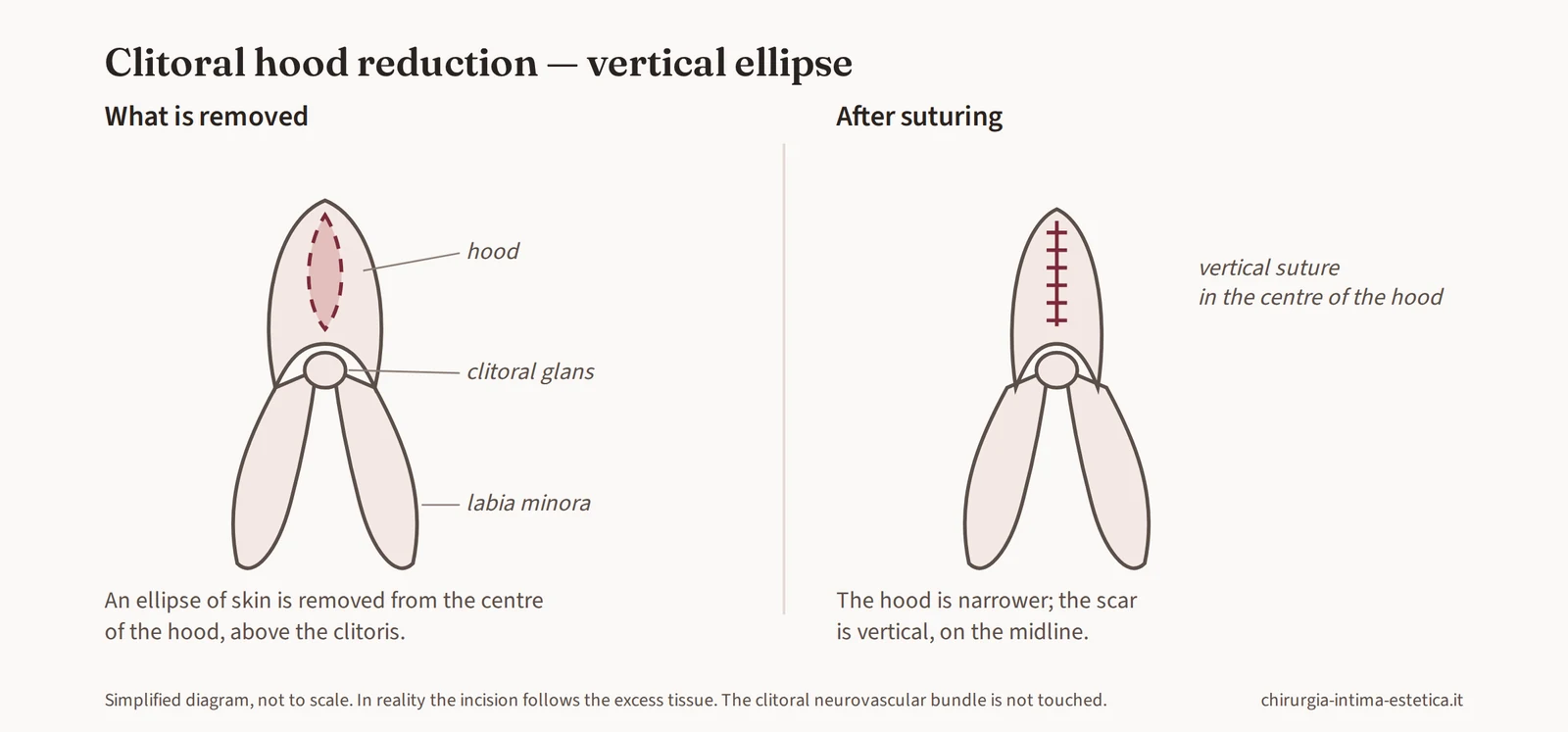 Diagram of hood reduction with a vertical diamond: removal of skin from the centre of the hood and vertical suture along the midline