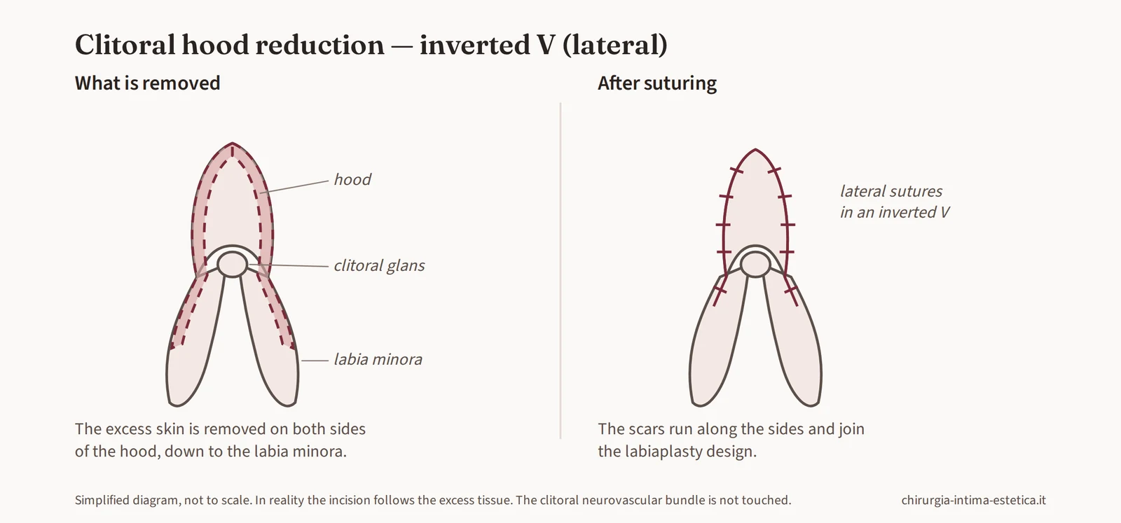 Diagram of inverted V hood reduction: removal of excess skin at the sides of the hood, continuous with the labia minora