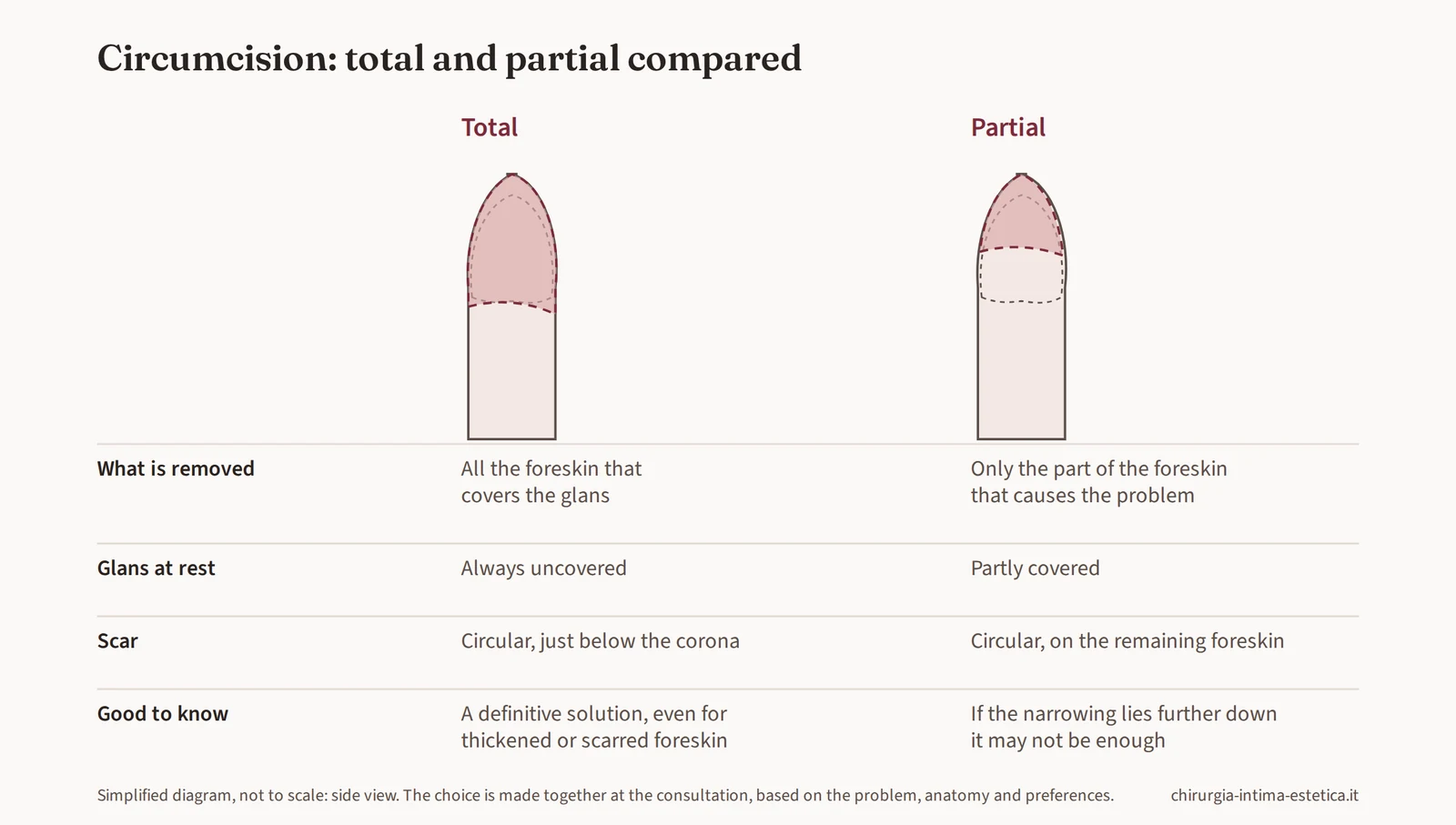 Diagram comparing total and partial circumcision: how much foreskin is removed, the glans at rest, the scar