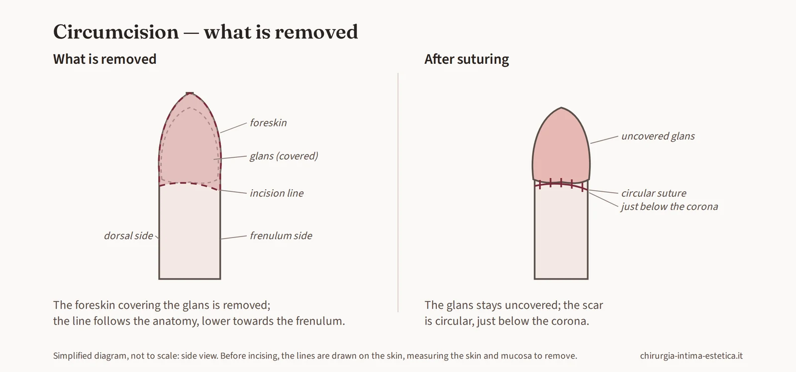 Side-view diagram of circumcision: the foreskin covering the glans is removed and the circular suture lies just below the corona