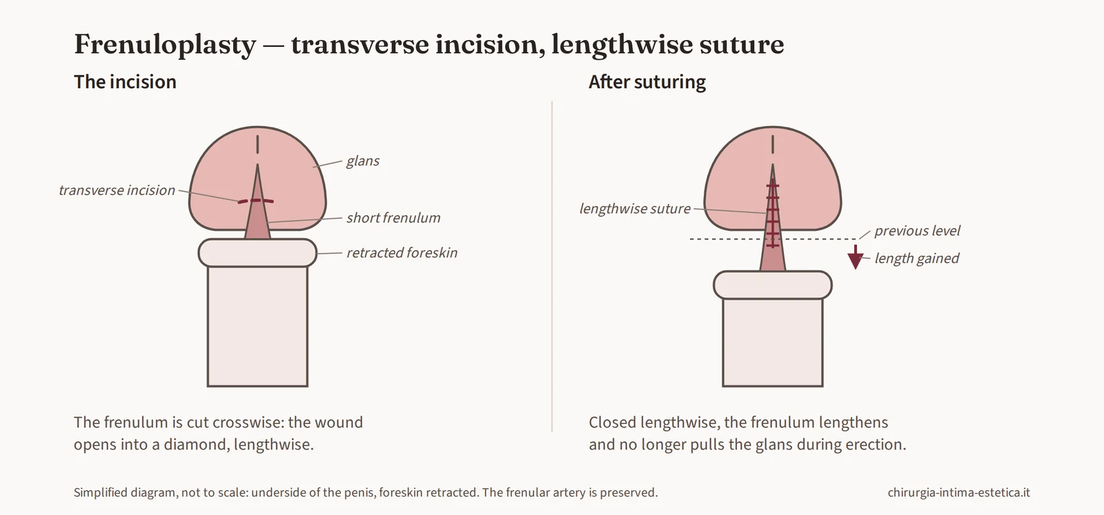 Diagram of frenuloplasty: transverse incision of the short frenulum and lengthwise suture that increases its length