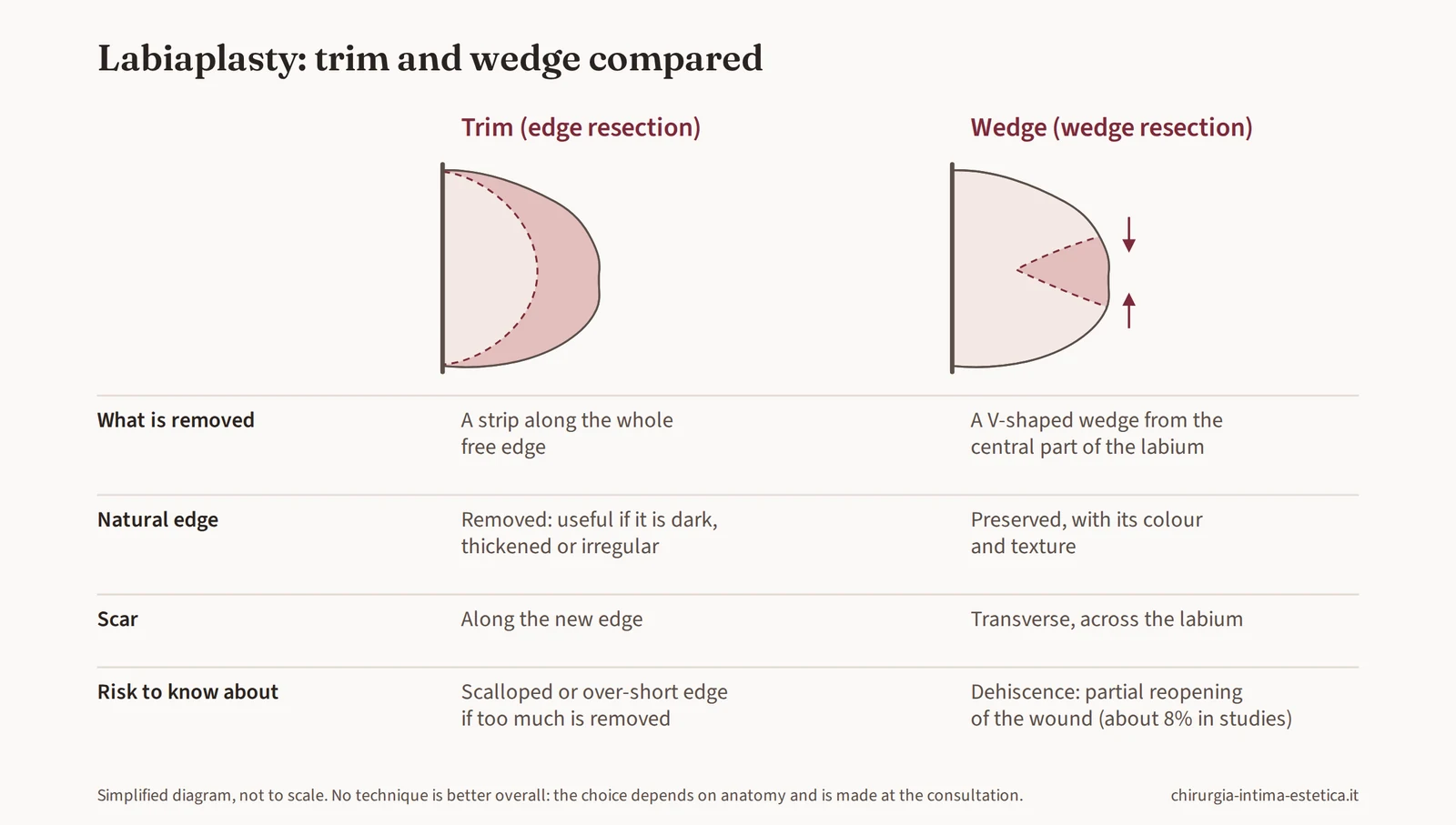 Diagram comparing trim and wedge labiaplasty: what is removed, natural edge, scar and main risk of each technique