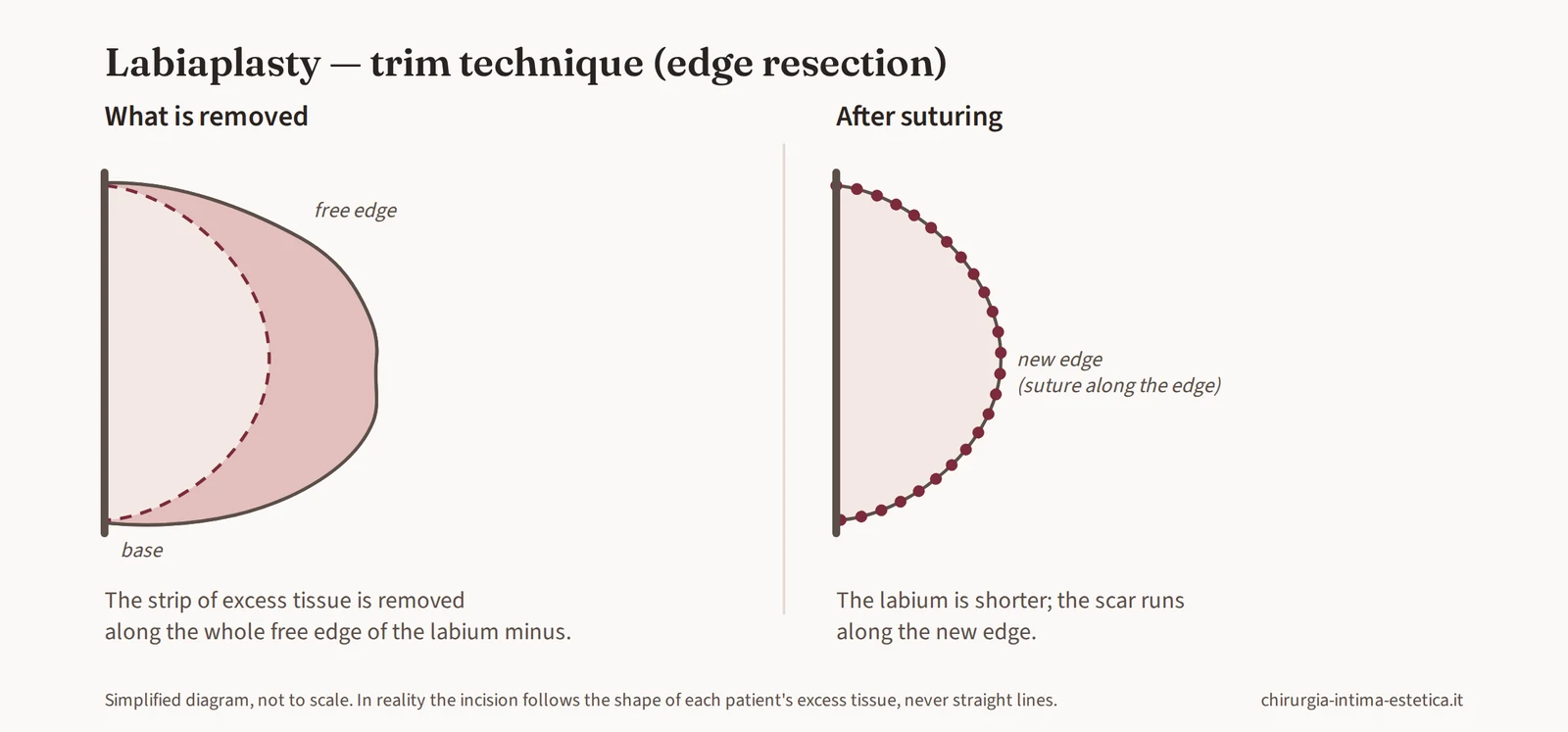 Diagram of trim labiaplasty: removal of a strip of tissue along the free edge of the labium minus, wider in the centre and tapering at the ends