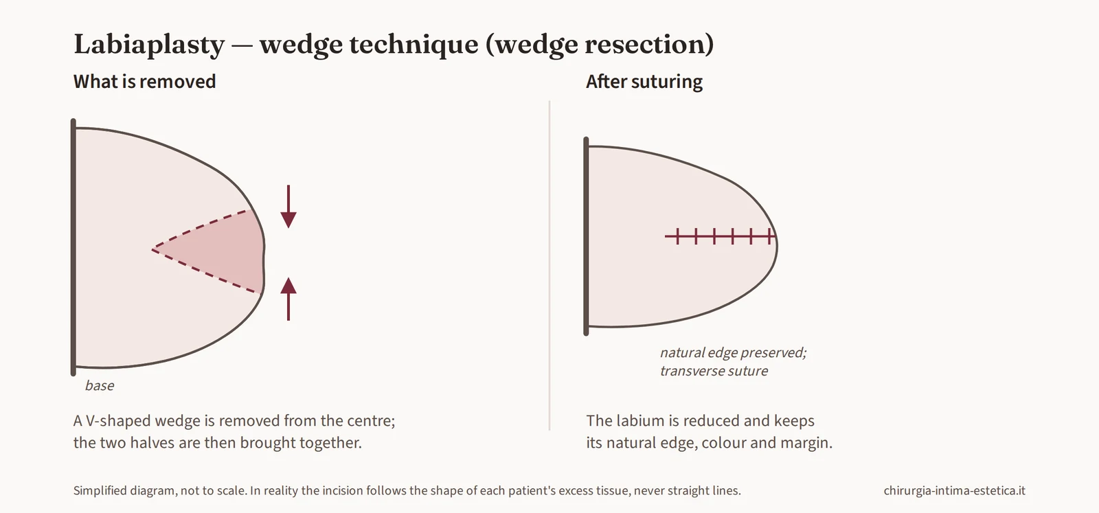 Diagram of wedge labiaplasty: removal of a V-shaped wedge from the central part of the labium minus and transverse suture that preserves the natural edge
