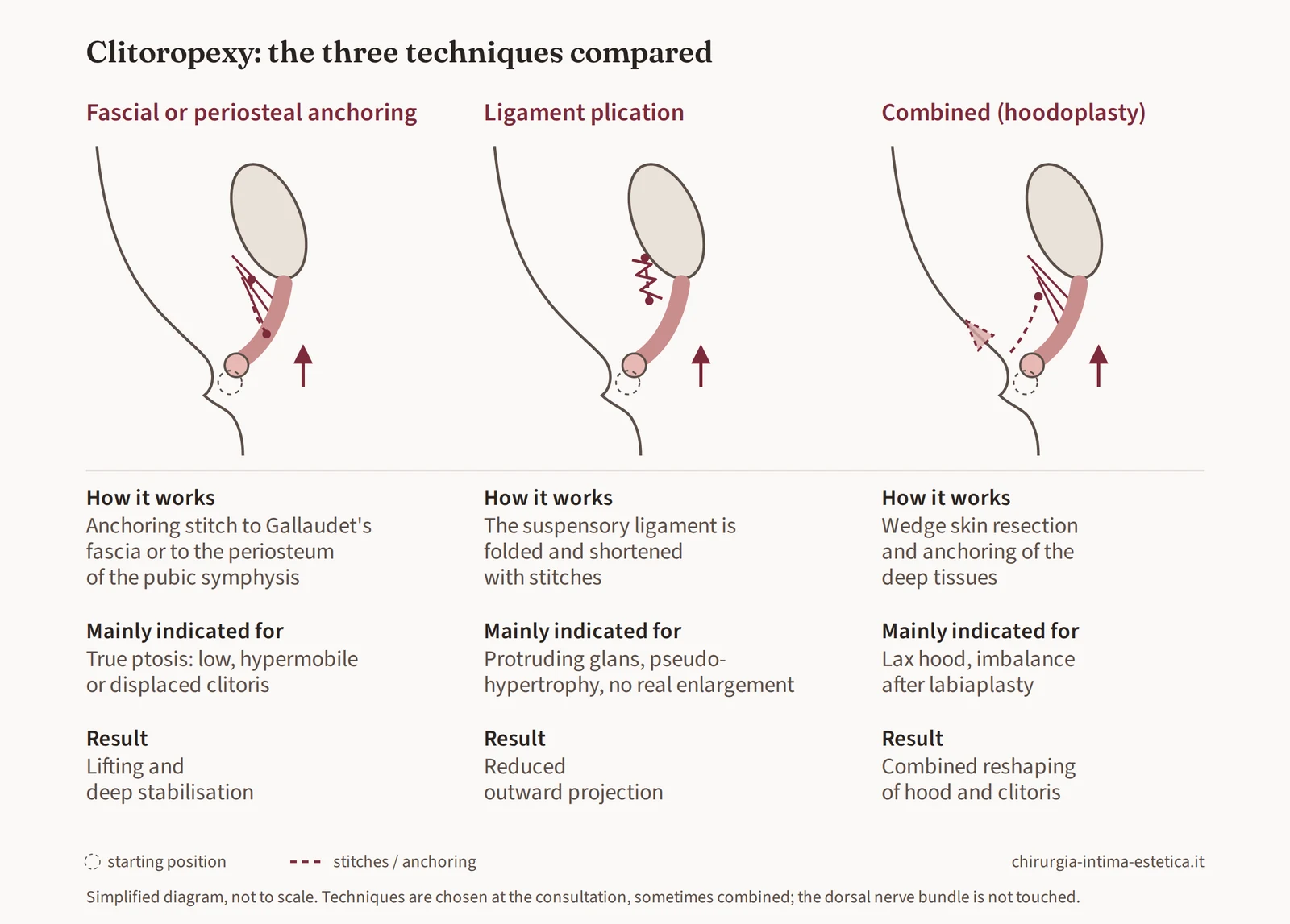 Diagram comparing the three clitoropexy techniques: fascial or periosteal anchoring, plication of the suspensory ligament, and pexy combined with hood reduction