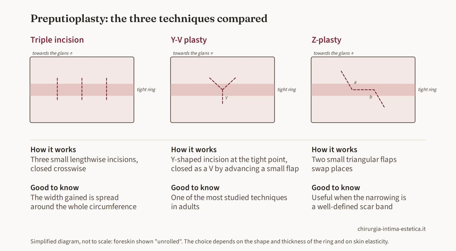 Diagram comparing the three preputioplasty techniques: triple incision, Y-V plasty and Z-plasty