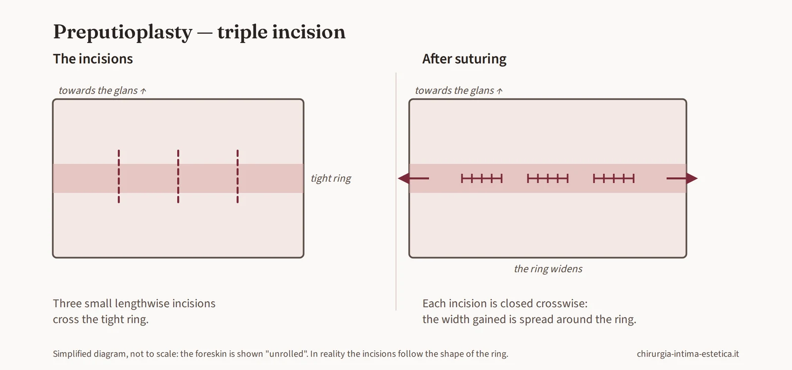 Diagram of the triple incision: three longitudinal incisions on the tight ring, closed transversely