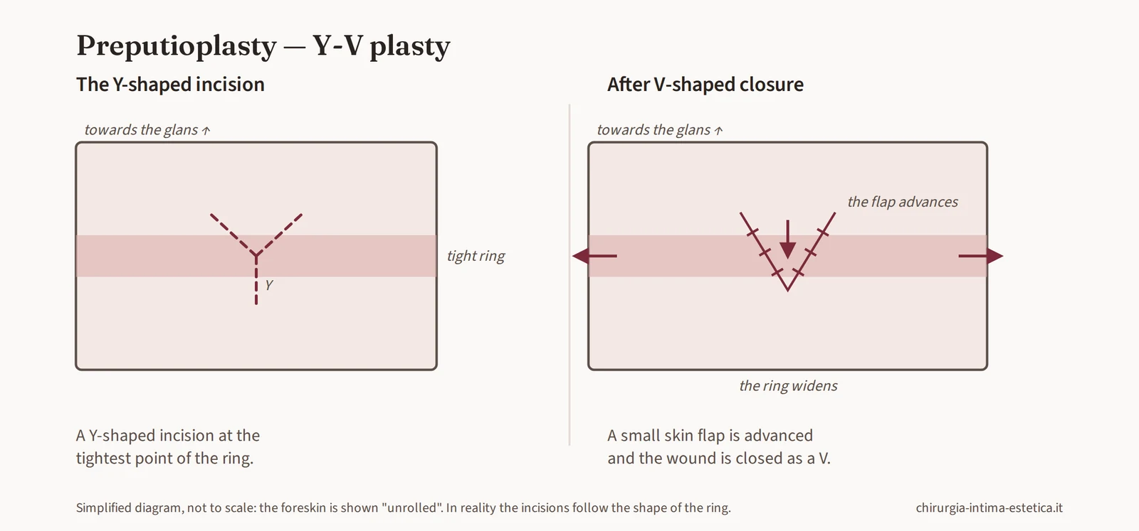 Diagram of Y-V plasty: Y-shaped incision on the tight point and V-shaped closure by advancing a small flap