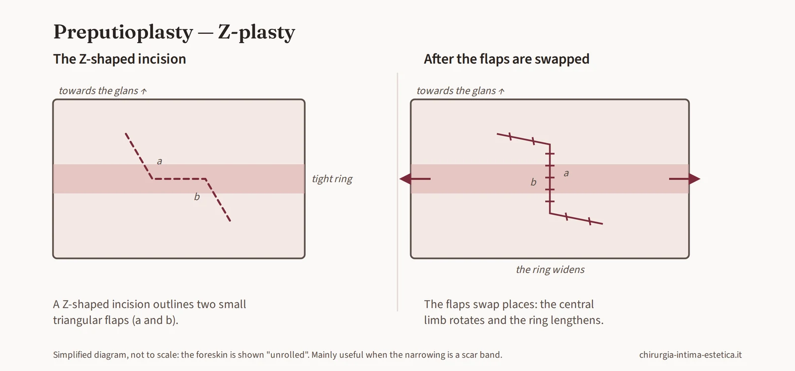 Diagram of Z-plasty: two triangular flaps swapped in position, widening the ring